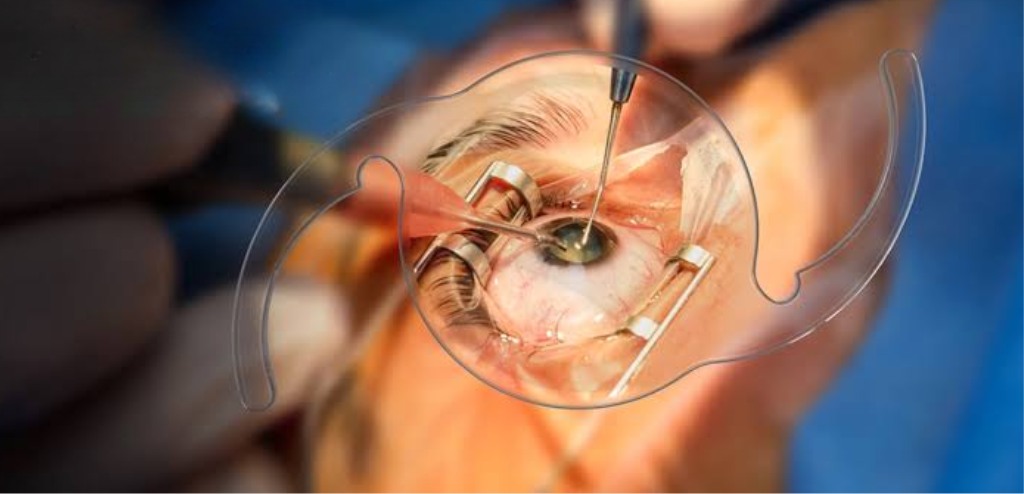 When Should You Get Cataract Surgery? Signs & Treatment