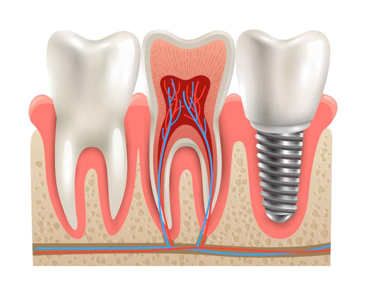 Single Dental Implant