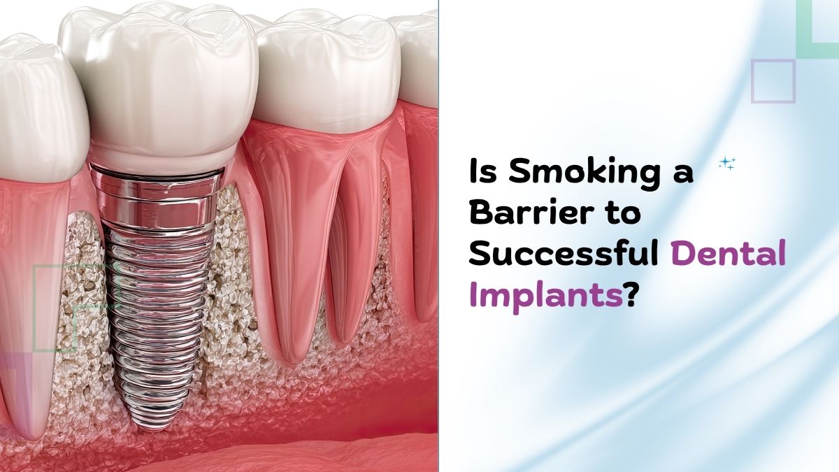 Is Smoking a Barrier to Successful Dental Implants?