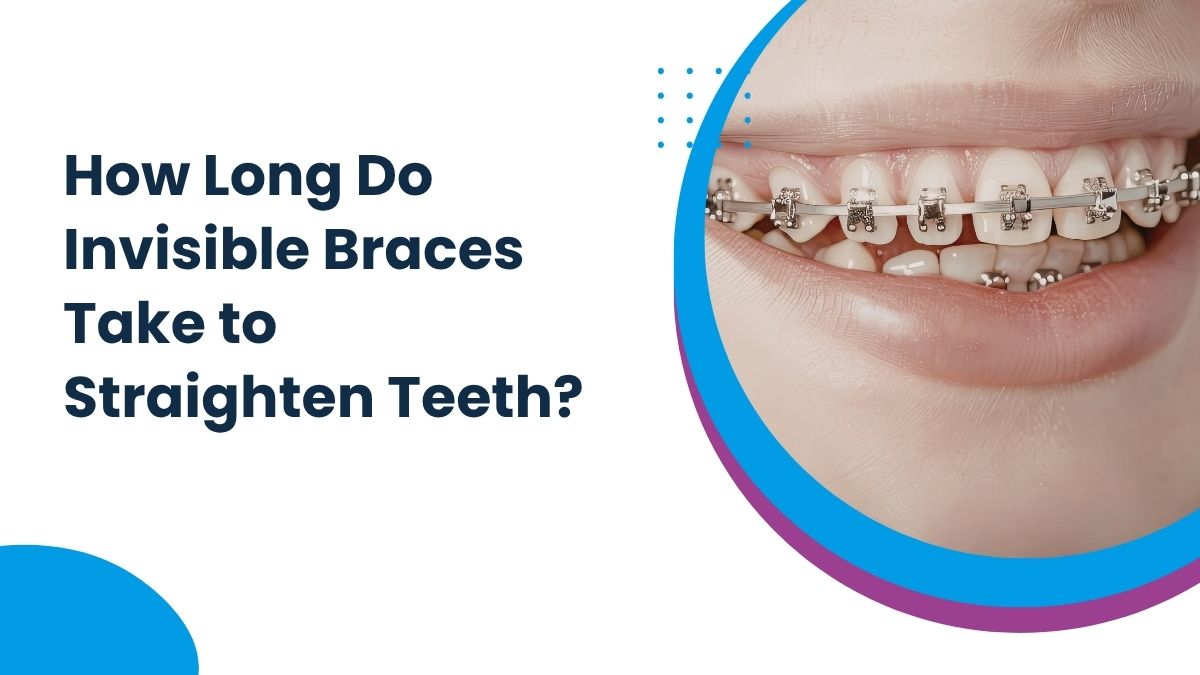 How Long Do Invisible Braces Take to Straighten Teeth?