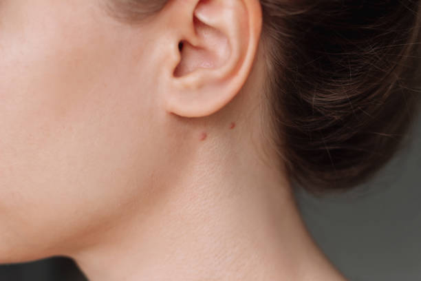 How to Remove Skin Tags in One Night: What Really Works and What to Avoid