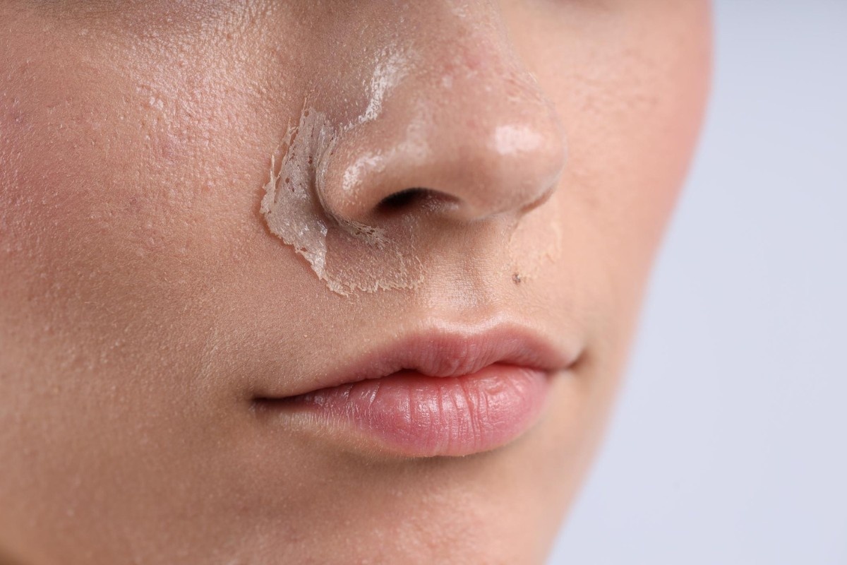 Dry Skin Treatment in Delhi: Advanced Solutions for Soft, Healthy, and Hydrated Skin
