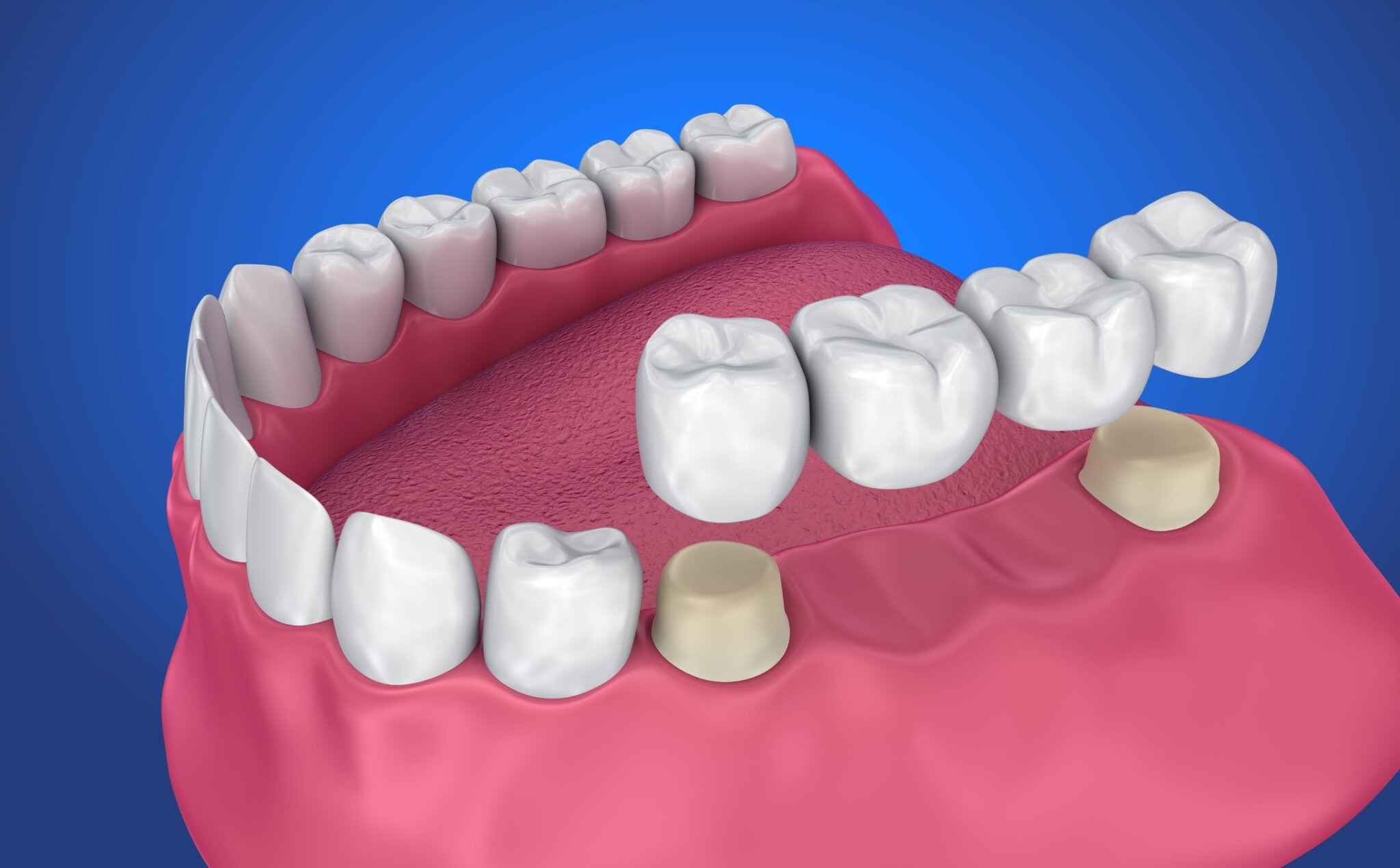 Teeth Cleaning Abu Dhabi: The Key to a Healthier and Brighter Smile