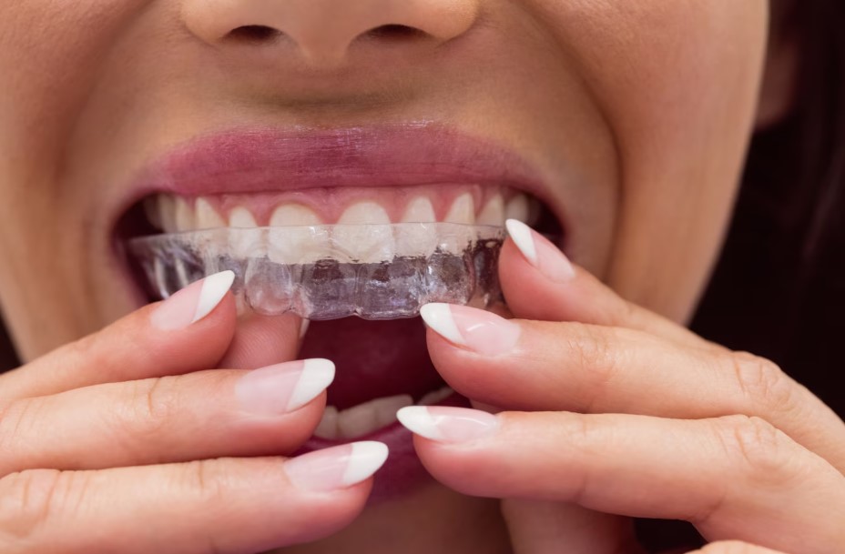 How to Choose the Best Invisalign in Raleigh, NC