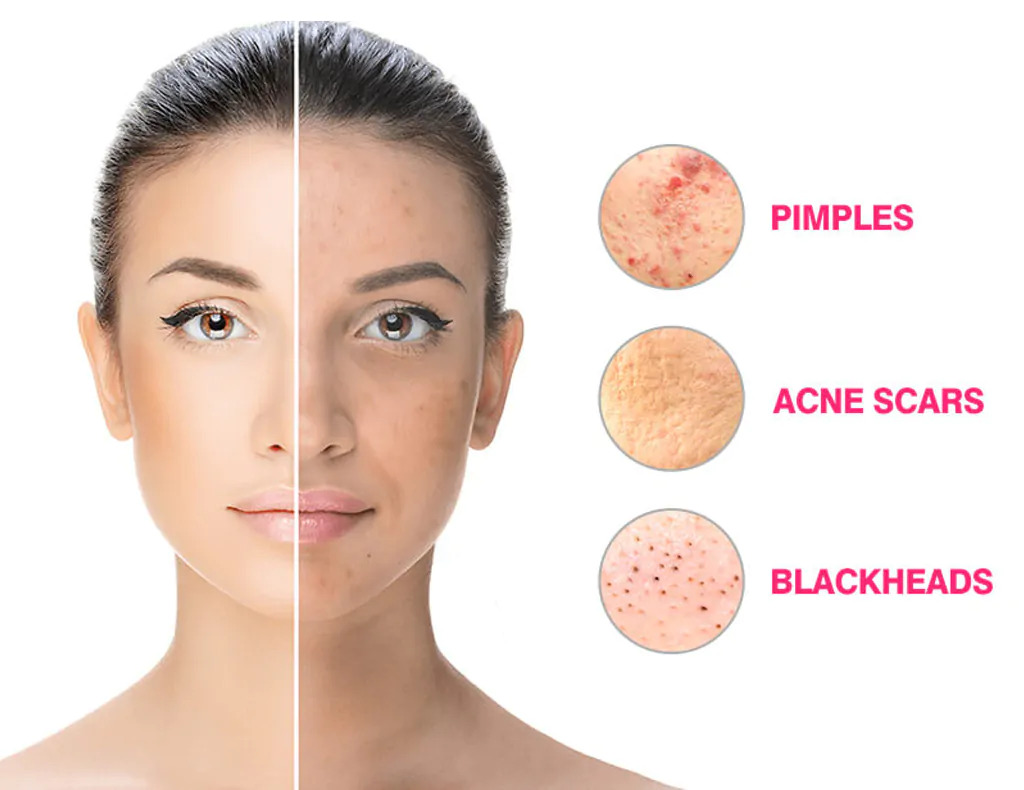 Acne Treatment: Exploring the Latest Research and Modern Approaches