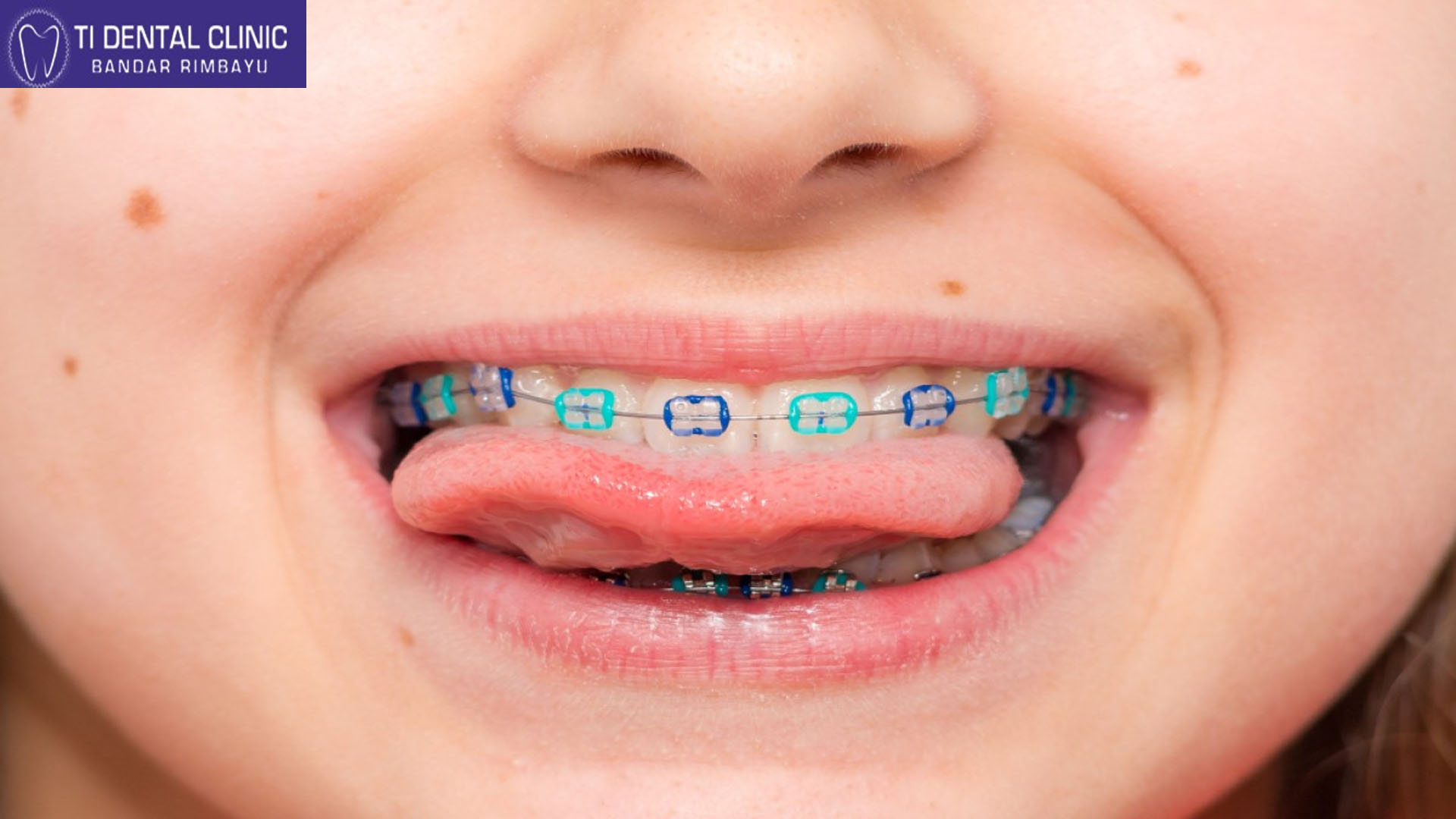 How Long Does Invisible Braces Treatment Take?