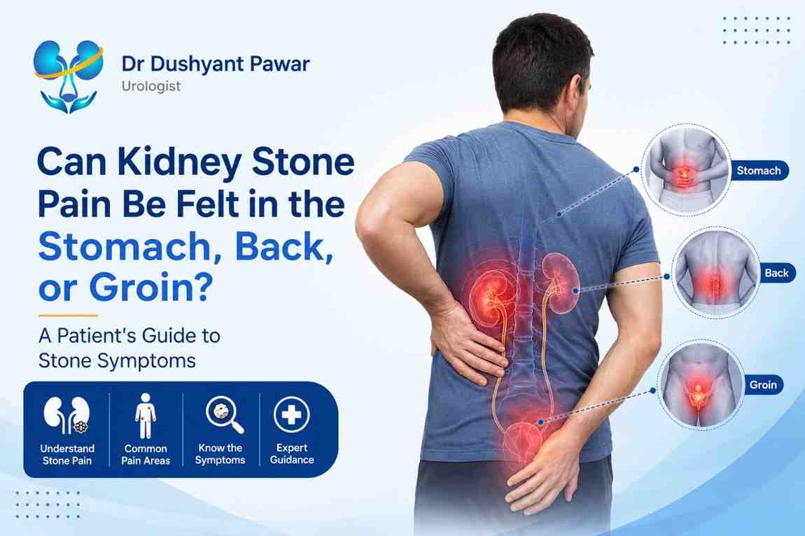 Can Kidney Stone Pain Be Felt in the Stomach, Back, or Groin? A Patient's Guide to Stone Symptoms