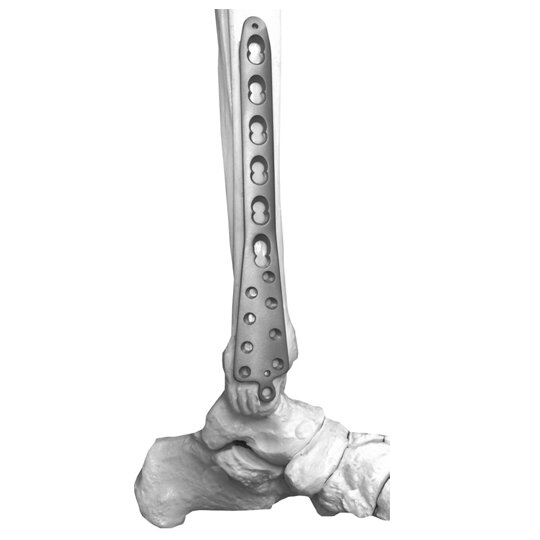 Bone Fixation Plates Market Size Analysis Revealing Industry Growth Patterns