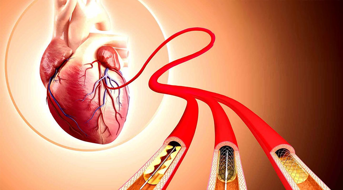 Best Angiography and Angioplasty Hospital in Chandigarh – Kare Partners Heart Centre