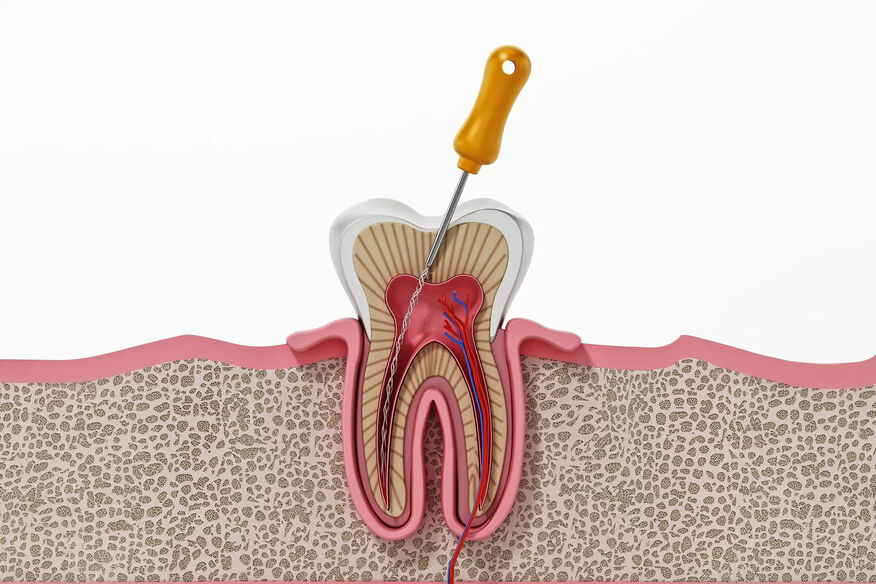 Root Canal Treatment in Basingstoke: What Patients Need to Know