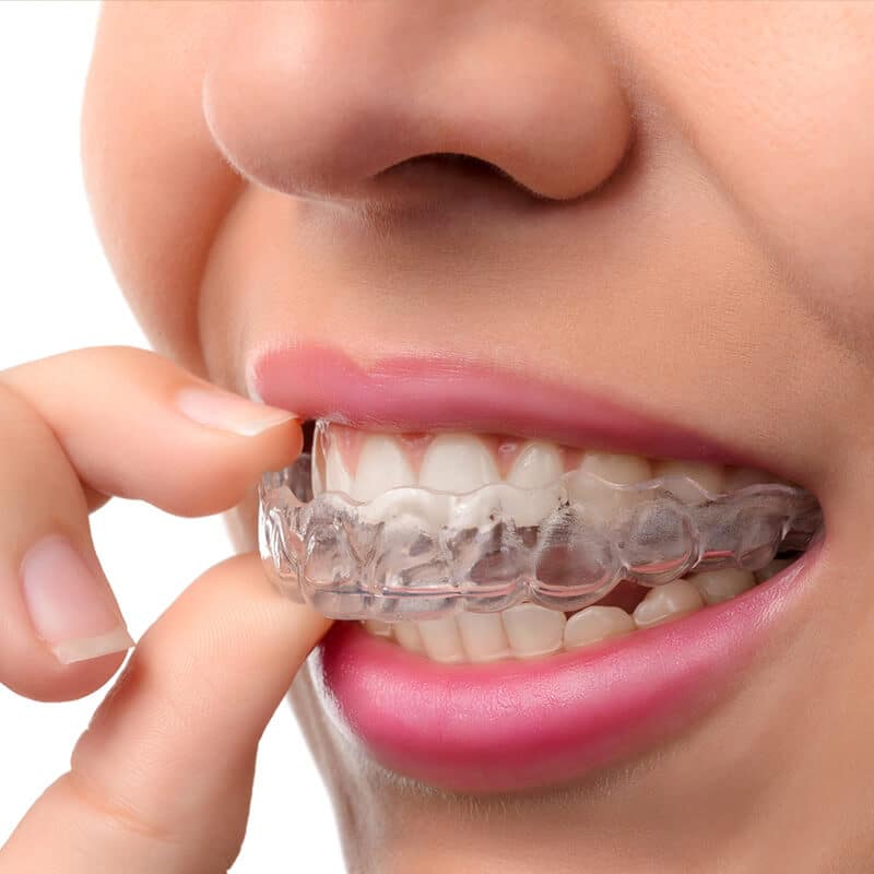 Invisalign Treatment: Cost, Benefits, Process & Results in India