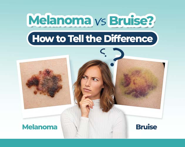 How to Check Whether It Is a Bruised Toenail or Melanoma?