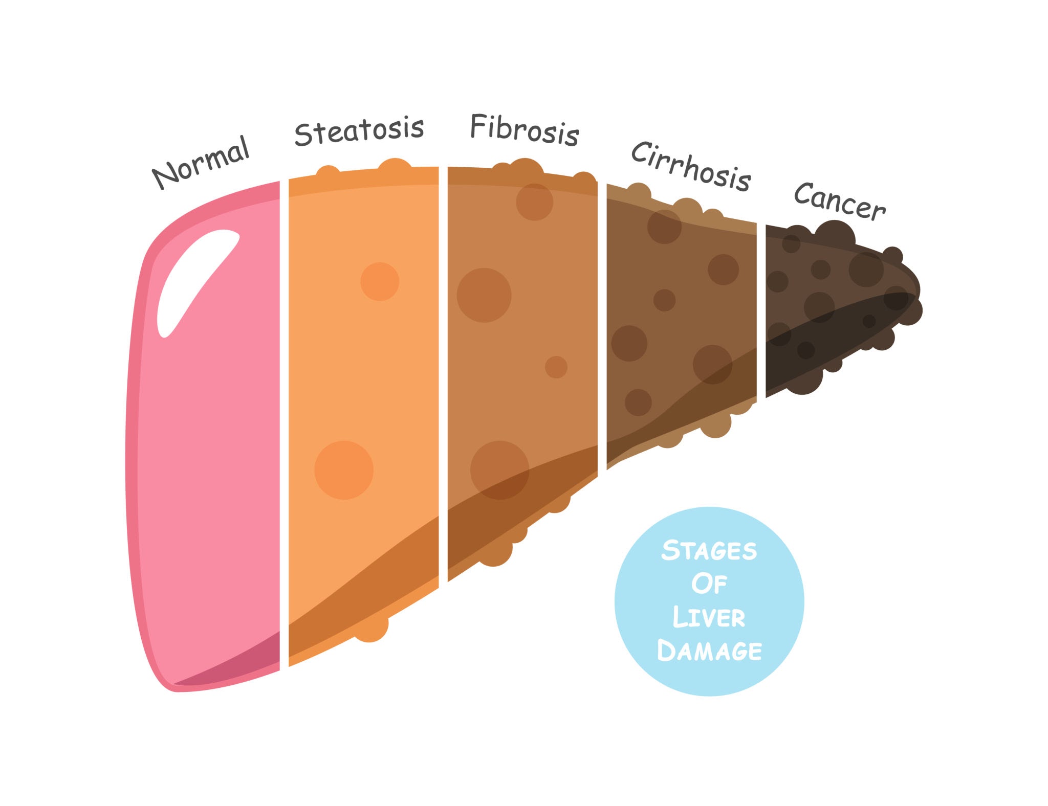 Fatty Liver Disease: Symptoms, Causes, Grades, Treatment & When to See a Doctor