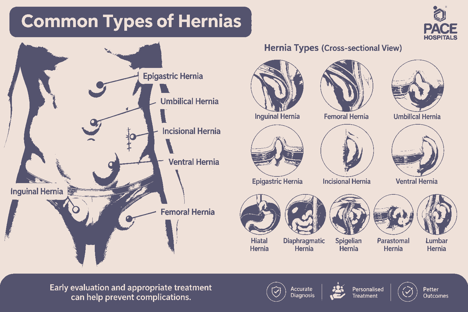 Hernia Surgery in Hyderabad: Types, Procedures and Recovery
