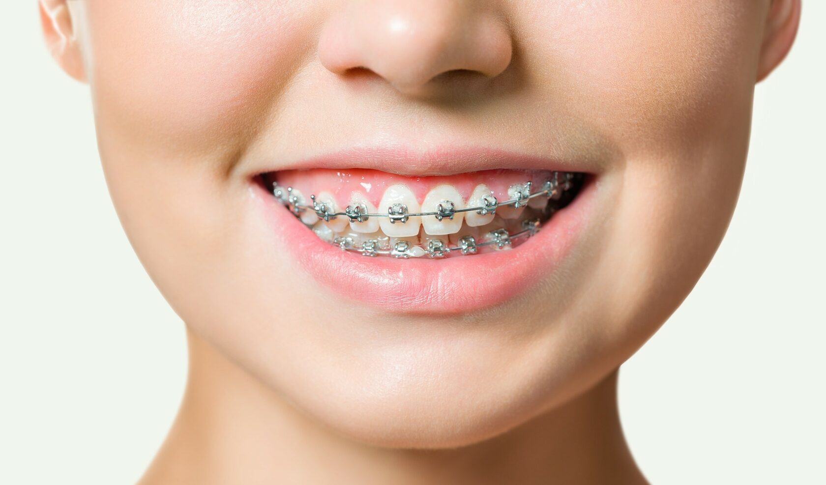 Braces Basingstoke: Treatment Options for Children, Teenagers and Adults