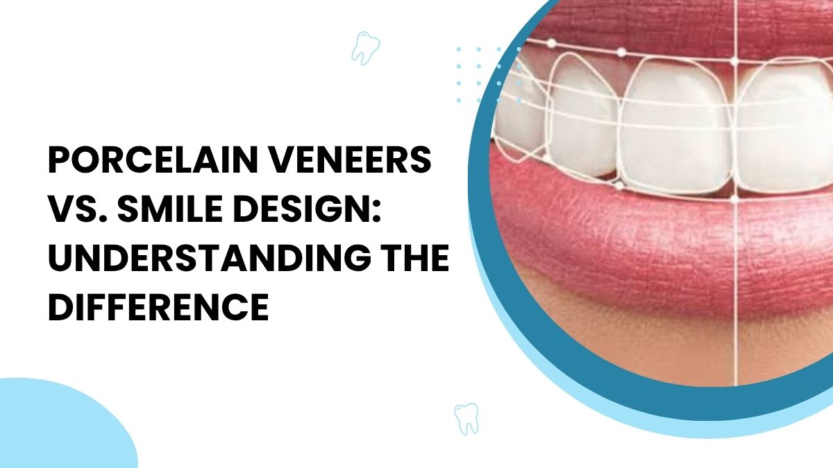 Porcelain Veneers vs. Smile Design: Understanding the Difference