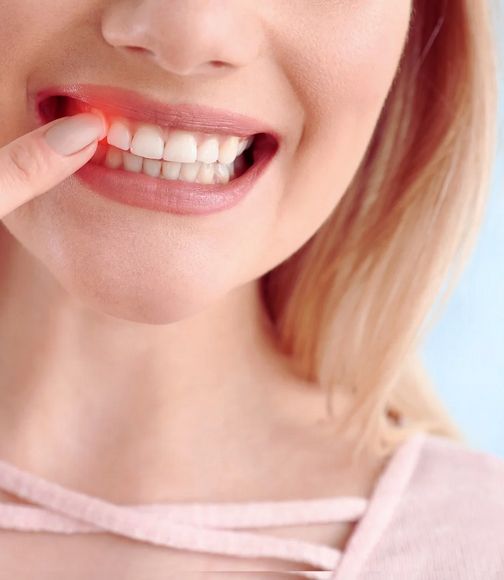 Wisdom Teeth Extraction Consultation in Pointe-Claire: What to Expect