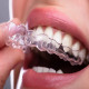 How Aligners Are Revolutionizing Orthodontic Treatment in Dubai